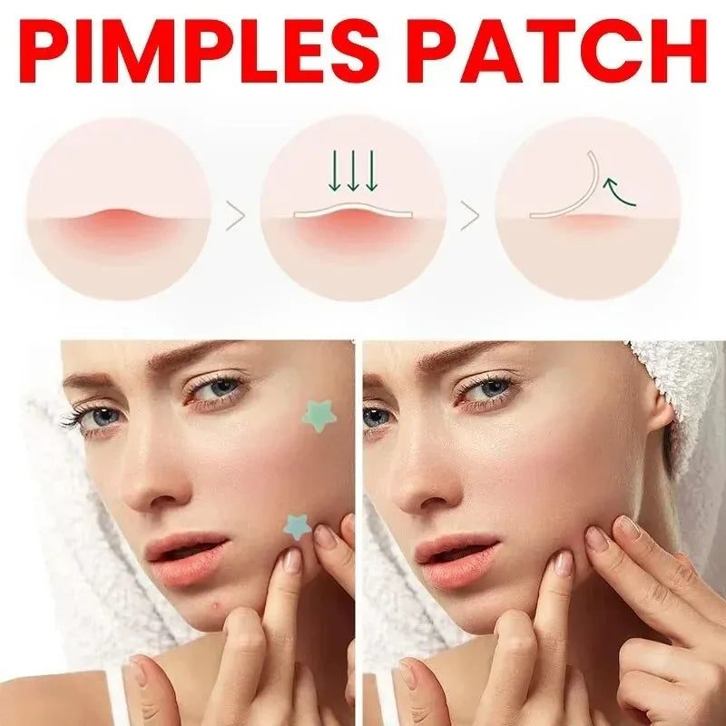 200pcs Facial Acne Pimple Repair Patch Cover