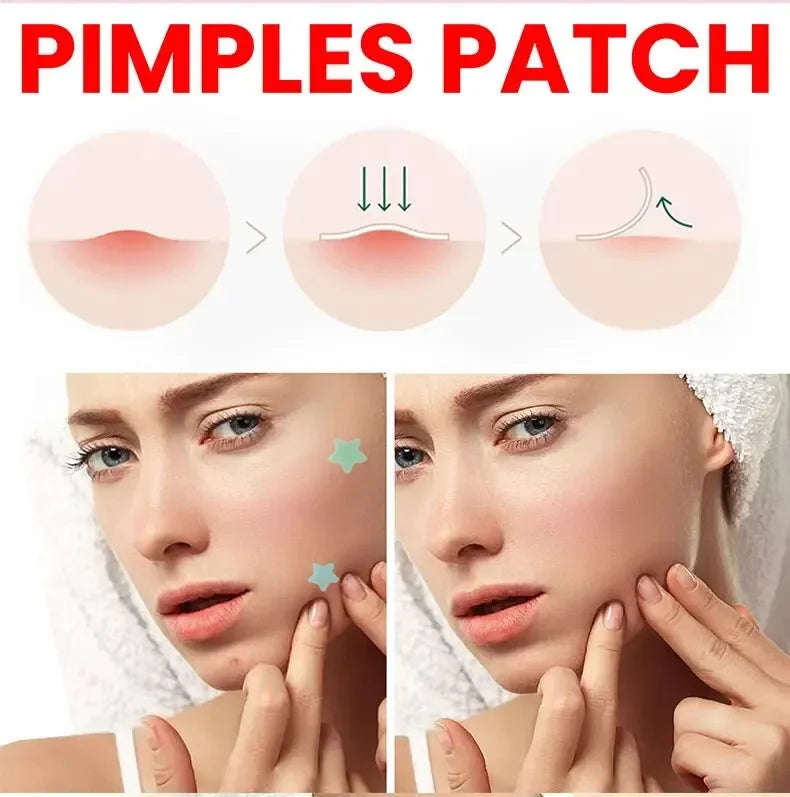 200pcs Facial Acne Pimple Repair Patch Cover